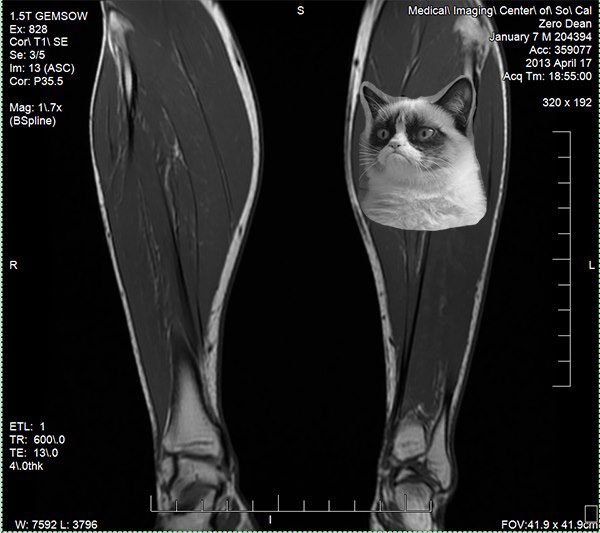 zero-dean-grumpy-calf-mri